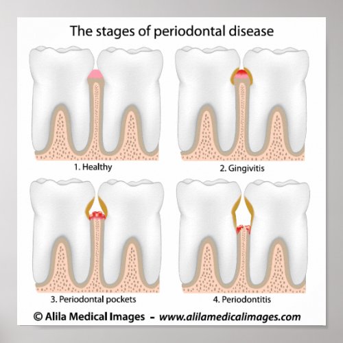 Tooth Periodontal Disease Poster