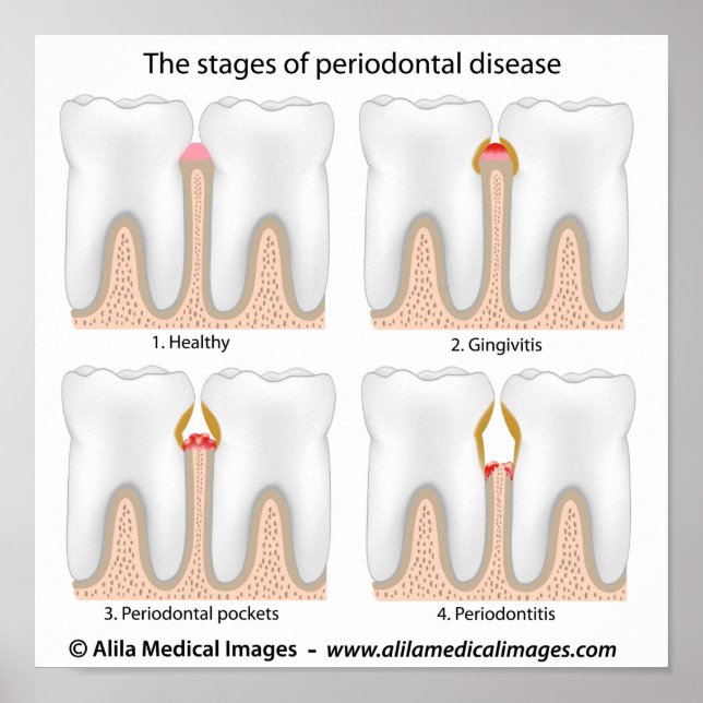 Tooth Periodontal Disease Poster (Front)