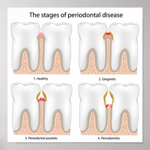 Tooth Periodontal Disease Poster