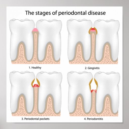 Tooth Periodontal Disease Poster | Zazzle