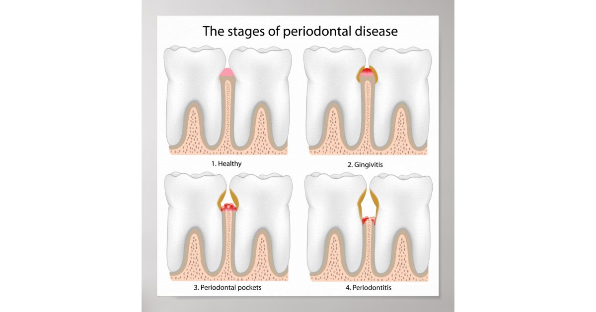 Tooth Periodontal Disease Poster | Zazzle