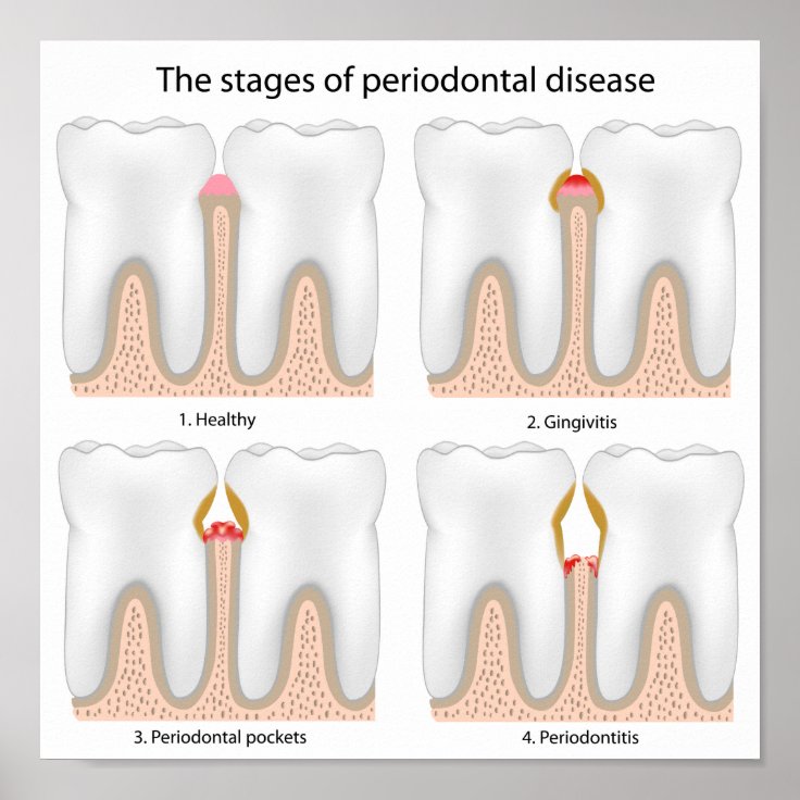 Tooth Periodontal Disease Poster | Zazzle