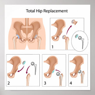 Total hip replacement surgery poster