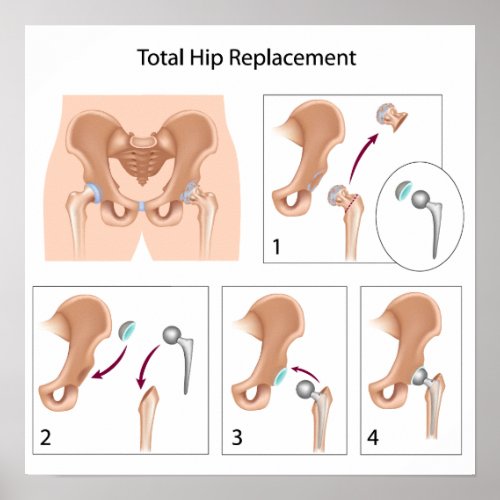 Total hip replacement surgery print