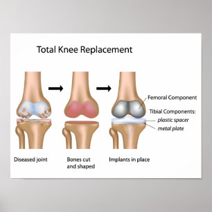 Total knee replacement surgery poster