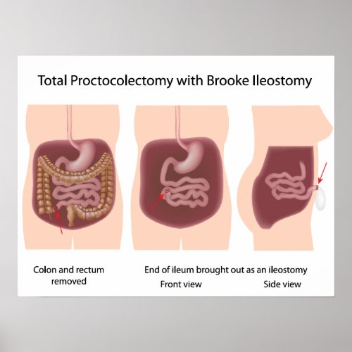 Total proctocolectomy with Brooke ileostomy poster