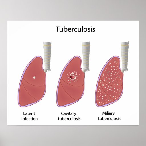 Tuberculosis types Poster | Zazzle