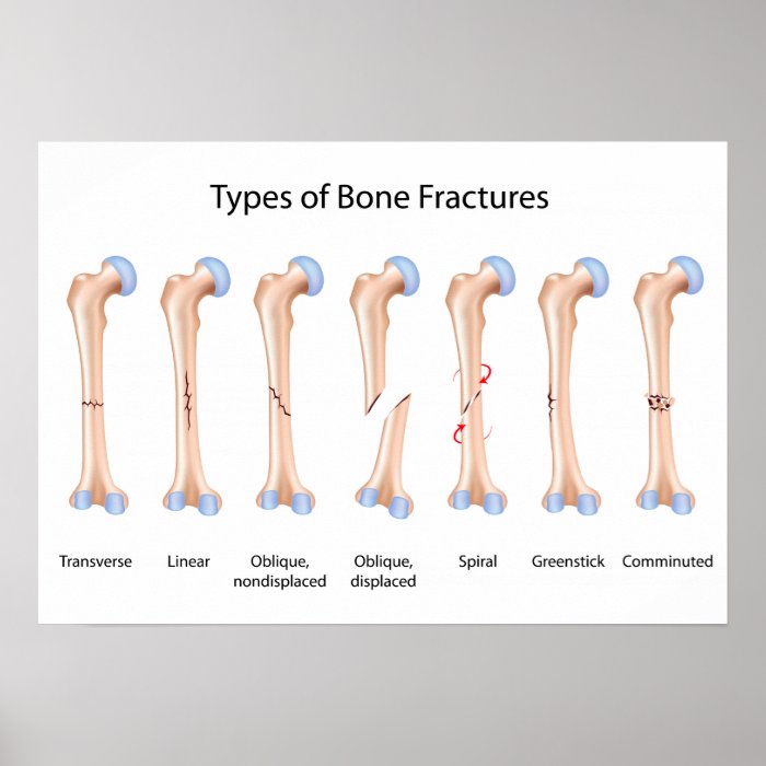 Types of bone fractures Poster