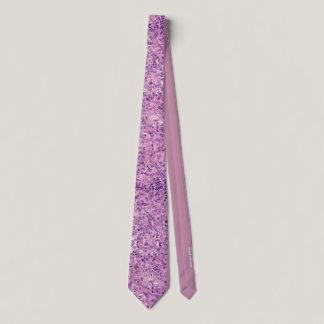 Uveal melanoma mixed cell type neck tie