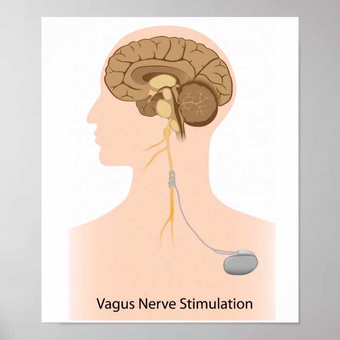 Vagus nerve stimulation therapy Poster