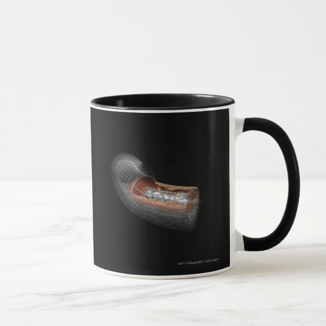 View of an angioplaty balloon in an artery mug (Right)