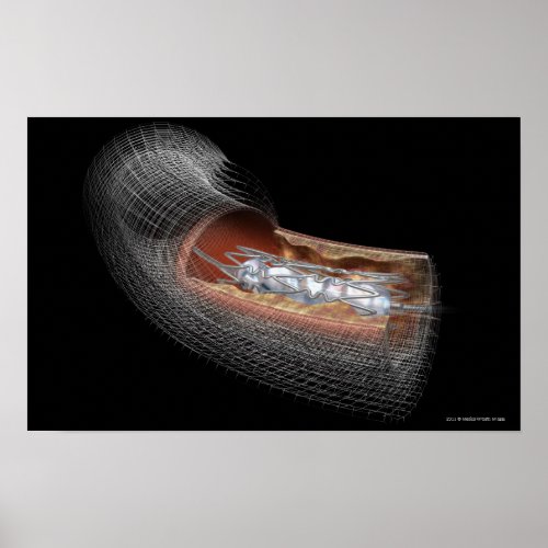 View of an angioplaty balloon in an artery poster