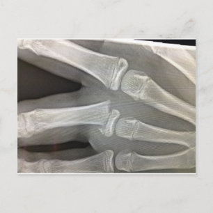 x-ray broken bone get well soon postcard