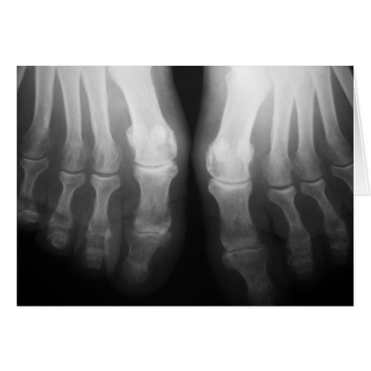 X-Ray Feet Human Skeleton Bones Black & White (Front Horizontal)