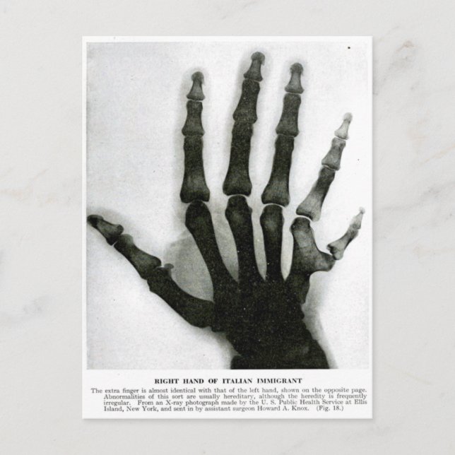 X-Ray Hand with Extra Finger Postcard (Front)