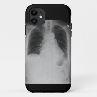 X Ray ~ iPhone 5 CaseMate case