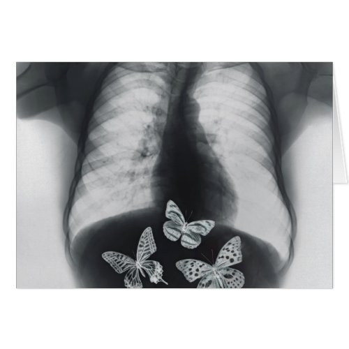 X_ray of butterflies in the stomach