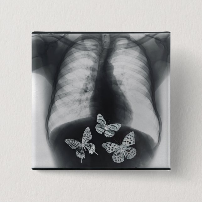 X-ray of butterflies in the stomach button (Front)