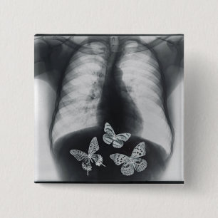 X-ray of butterflies in the stomach button