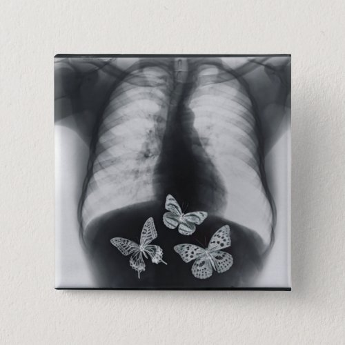 X_ray of butterflies in the stomach button