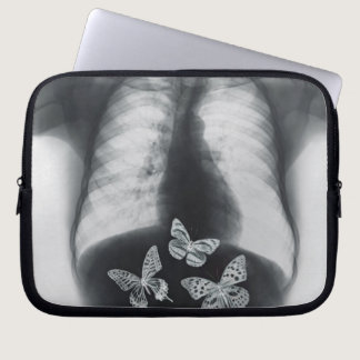 X-ray of butterflies in the stomach laptop sleeve