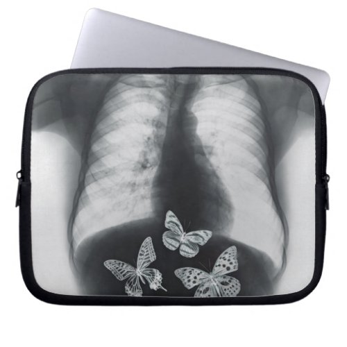 X_ray of butterflies in the stomach laptop sleeve