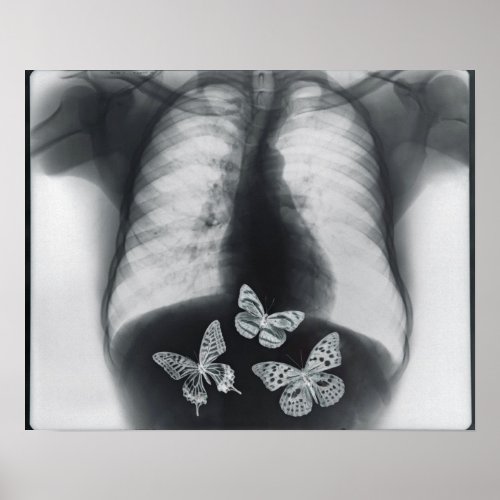X_ray of butterflies in the stomach poster