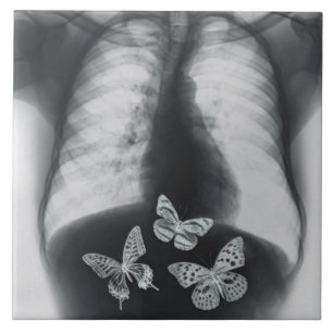 X-ray of butterflies in the stomach tile
