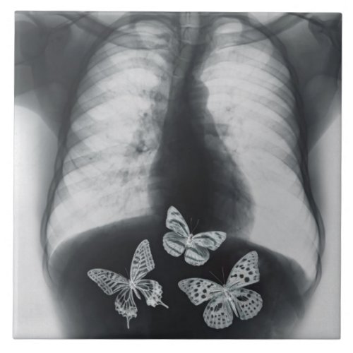 X_ray of butterflies in the stomach tile