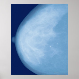 X-ray of female breast, side view poster