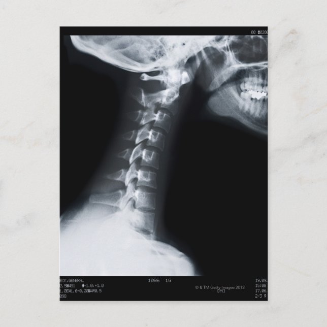 X ray of neck vertebrae including lower jaw postcard (Front)