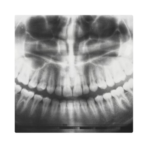 X_Ray Teeth Mouth Smile Black and White Metal Print