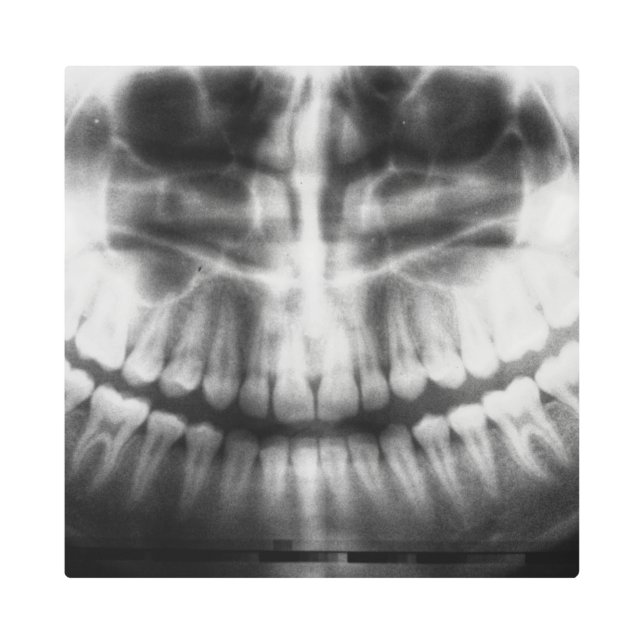 X-Ray Teeth Mouth Smile Black and White Metal Print (Front)