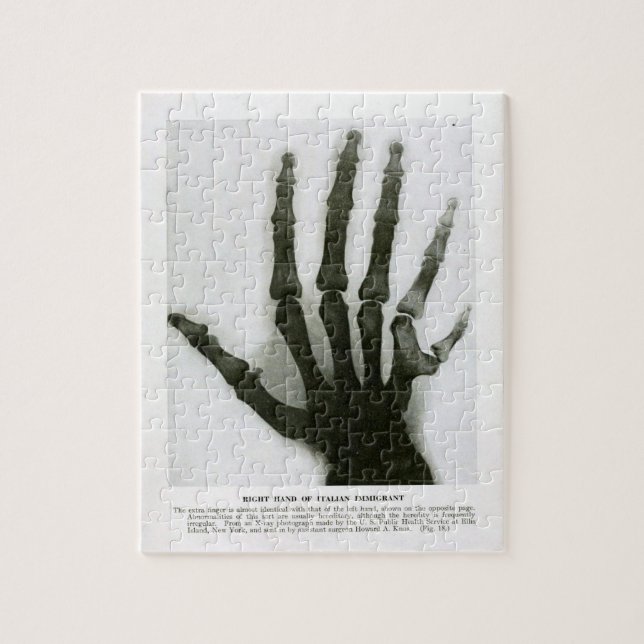 Xray of Six Fingered Hand Puzzle (Vertical)